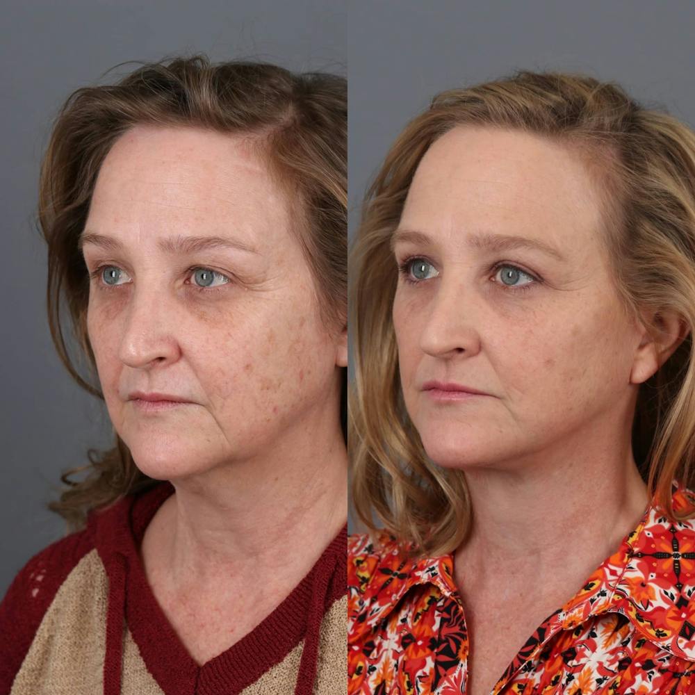Face & Neck Lift Before & After Gallery - Patient 312264 - Image 1