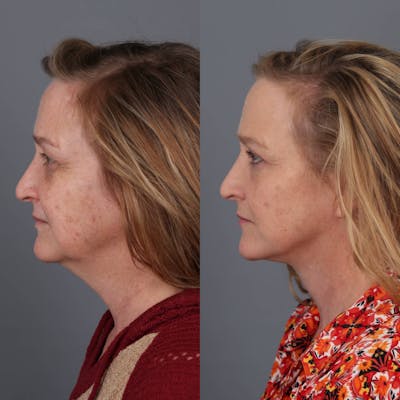 Face & Neck Lift Before & After Gallery - Patient 312264 - Image 2