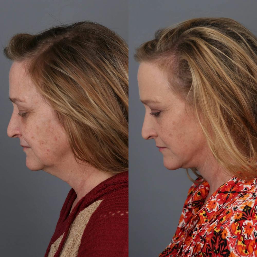 Face & Neck Lift Before & After Gallery - Patient 312264 - Image 3