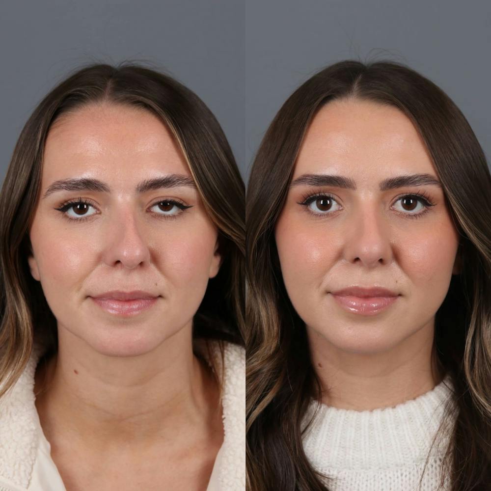 Rhinoplasty Before & After Gallery - Patient 417744 - Image 2