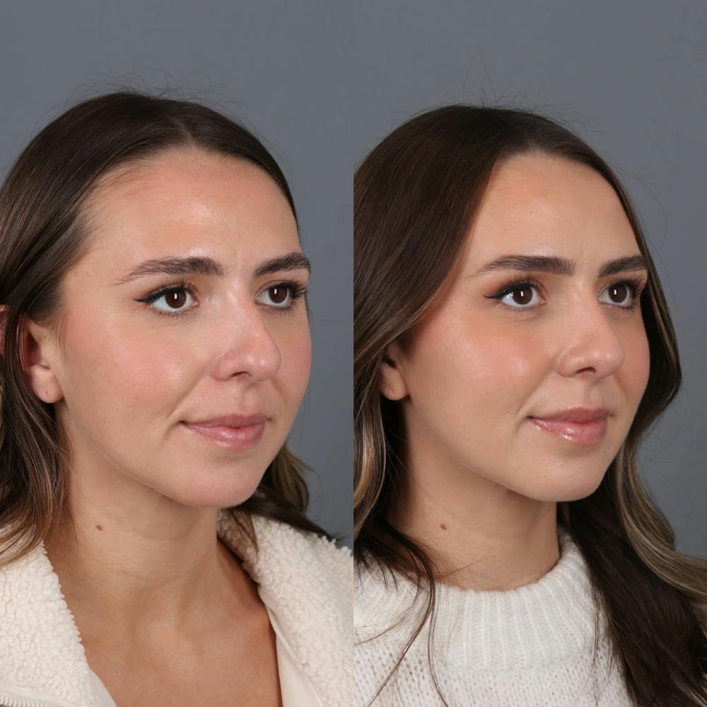 Rhinoplasty Before & After Gallery - Patient 417744 - Image 3
