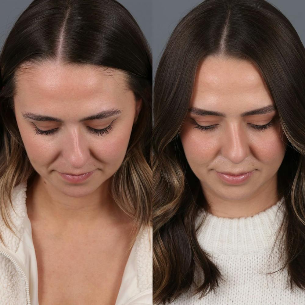 Rhinoplasty Before & After Gallery - Patient 417744 - Image 4