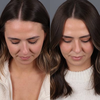 Rhinoplasty Before & After Gallery - Patient 417744 - Image 4