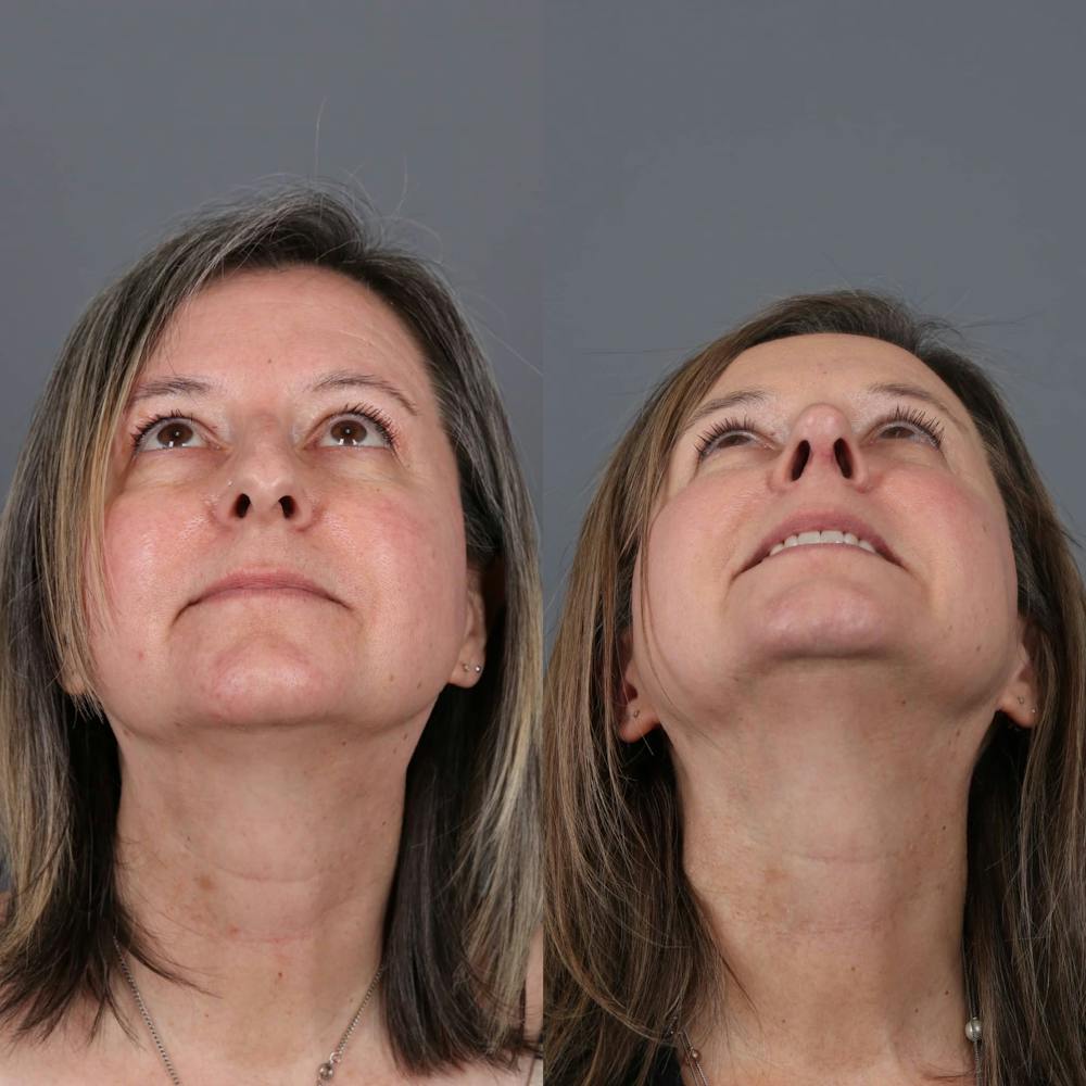 Rhinoplasty Before & After Gallery - Patient 354578 - Image 4