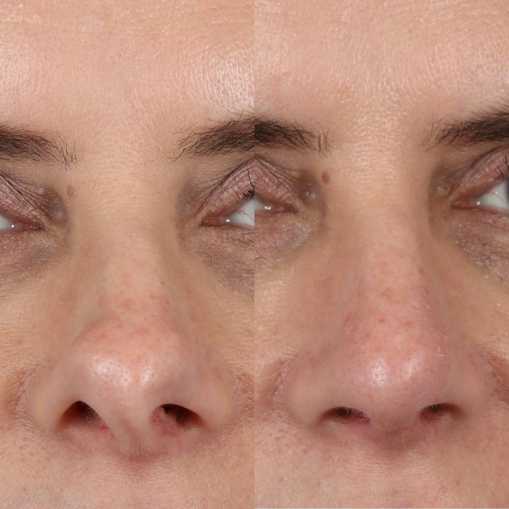 Rhinoplasty Before & After Gallery - Patient 231985 - Image 2