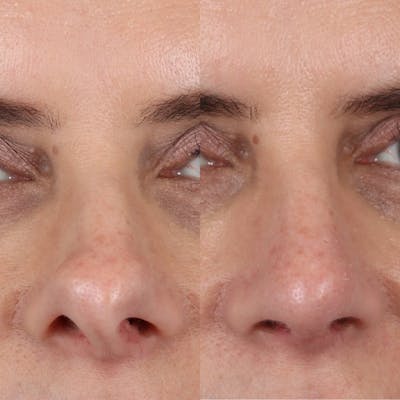 Rhinoplasty Before & After Gallery - Patient 231985 - Image 2