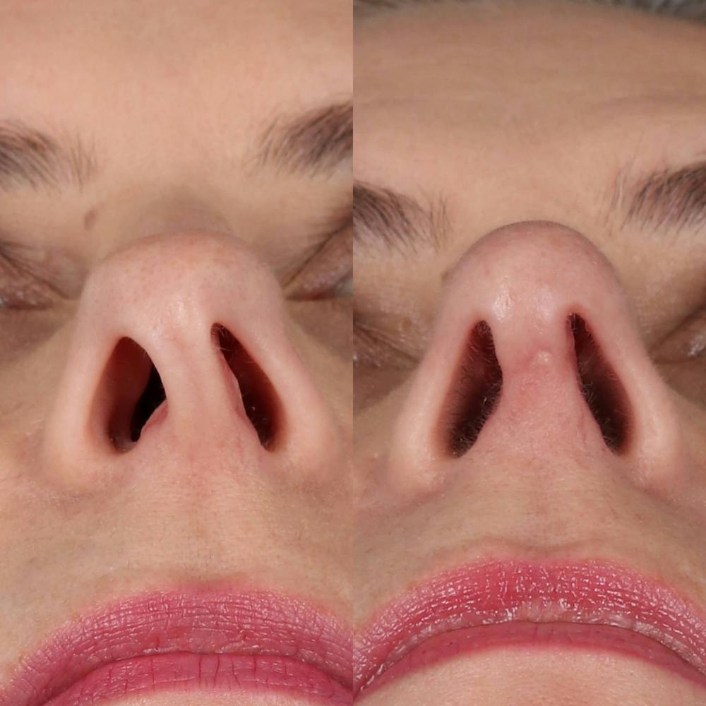 Rhinoplasty Before & After Gallery - Patient 231985 - Image 4