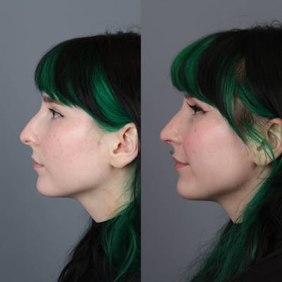 Rhinoplasty Before & After Gallery - Patient 281982 - Image 1