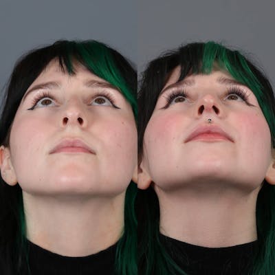 Rhinoplasty Before & After Gallery - Patient 281982 - Image 4