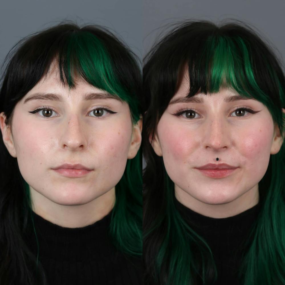 Rhinoplasty Before & After Gallery - Patient 281982 - Image 2