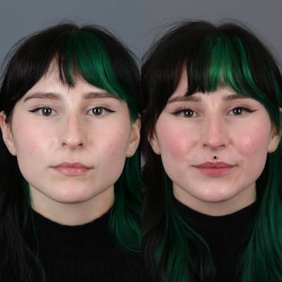 Rhinoplasty Before & After Gallery - Patient 281982 - Image 2