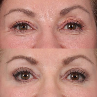 Upper Blepharoplasty Before & After Gallery - Patient 110253 - Image 1