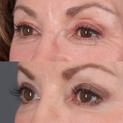 Upper Blepharoplasty Before & After Gallery - Patient 110253 - Image 2