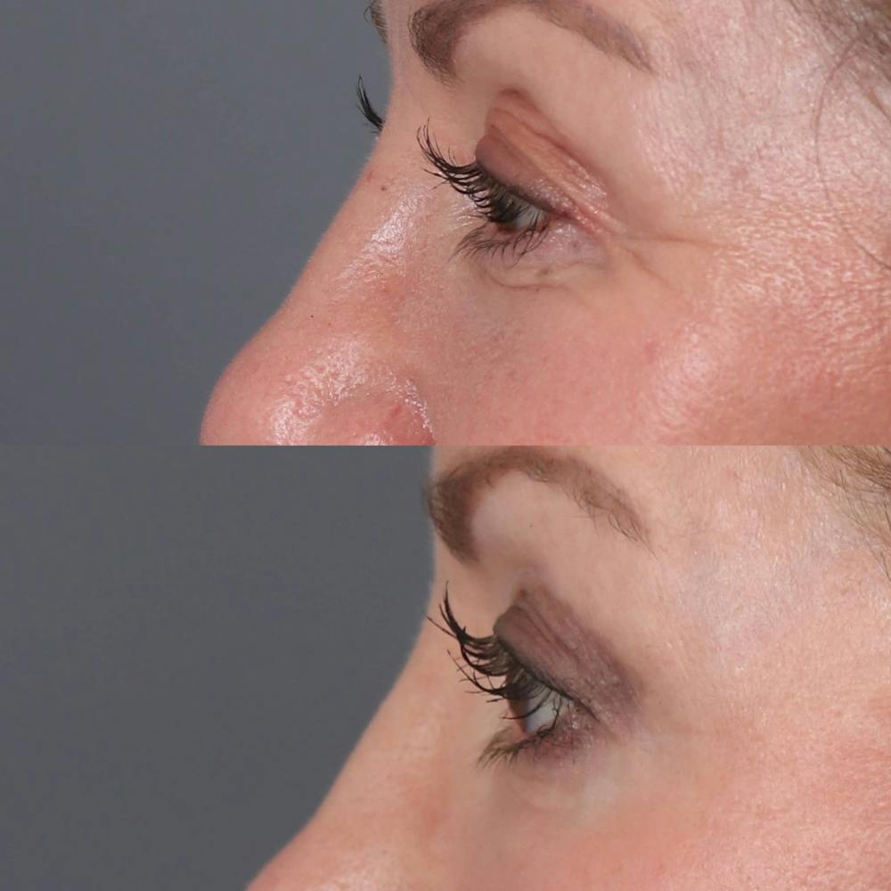 Upper Blepharoplasty Before & After Gallery - Patient 110253 - Image 3