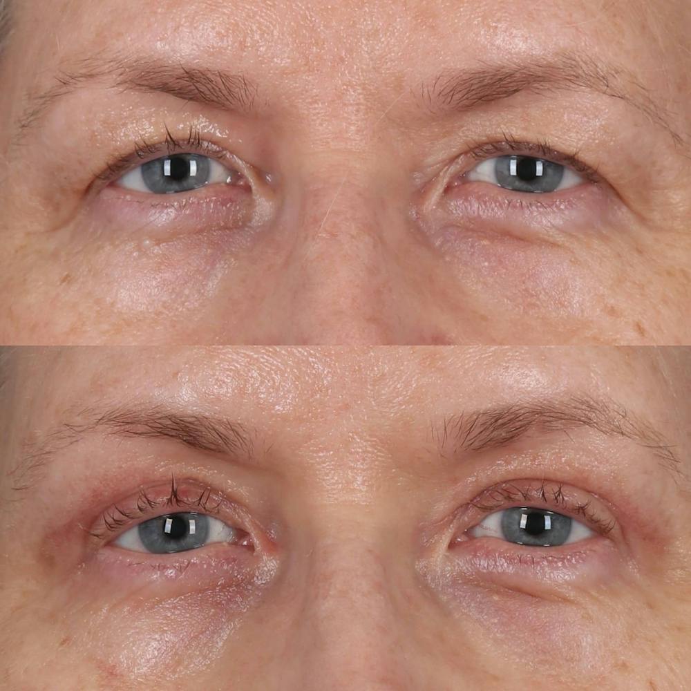 Upper Blepharoplasty Before & After Gallery - Patient 364927 - Image 1