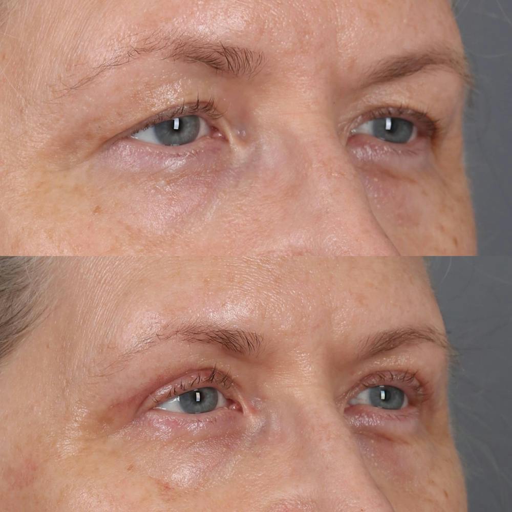 Upper Blepharoplasty Before & After Gallery - Patient 364927 - Image 2