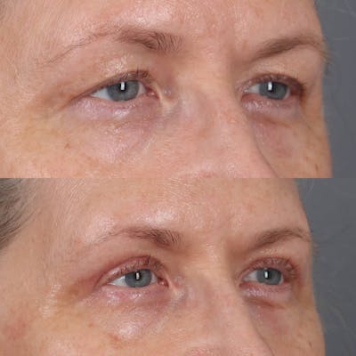 Upper Blepharoplasty Before & After Gallery - Patient 364927 - Image 2