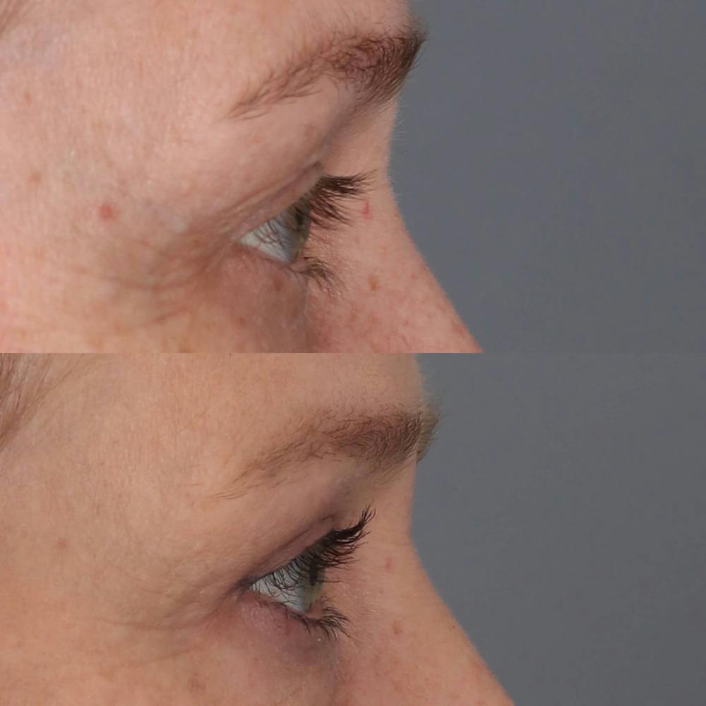 Upper Blepharoplasty Before & After Gallery - Patient 292676 - Image 3