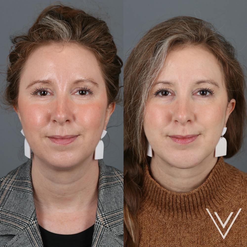 Chin Implant Before & After Gallery - Patient 405064 - Image 3