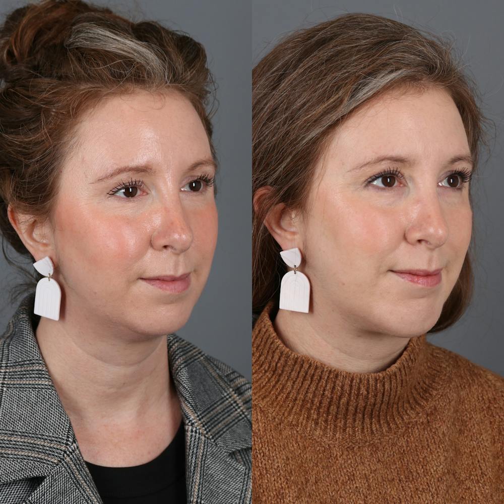 Face & Neck Lift Before & After Gallery - Patient 200839 - Image 1