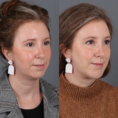 Face & Neck Lift Before & After Gallery - Patient 200839 - Image 1