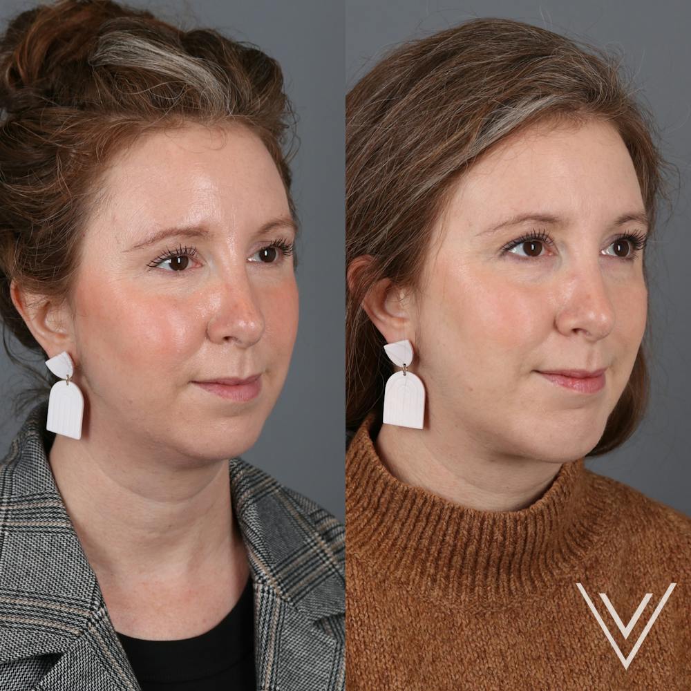 Chin Implant Before & After Gallery - Patient 405064 - Image 4