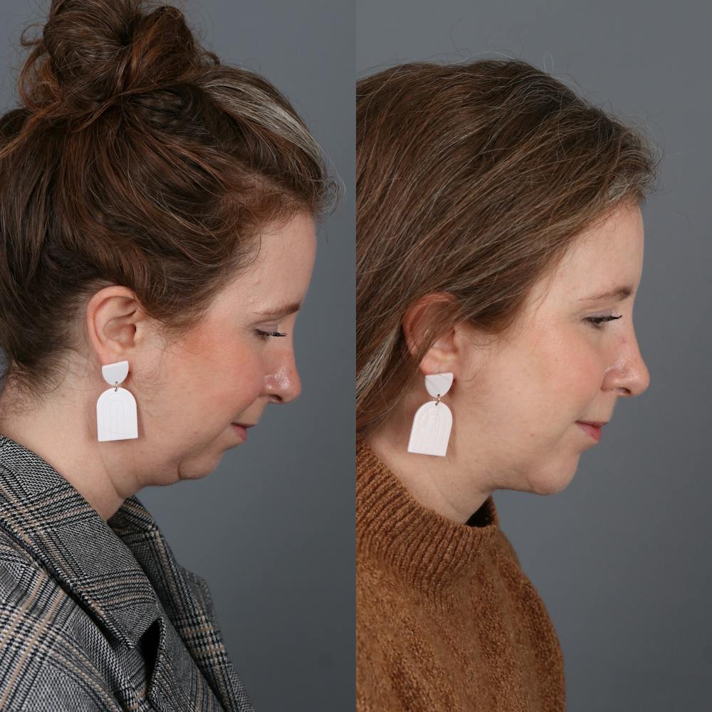 Face & Neck Lift Before & After Gallery - Patient 200839 - Image 3
