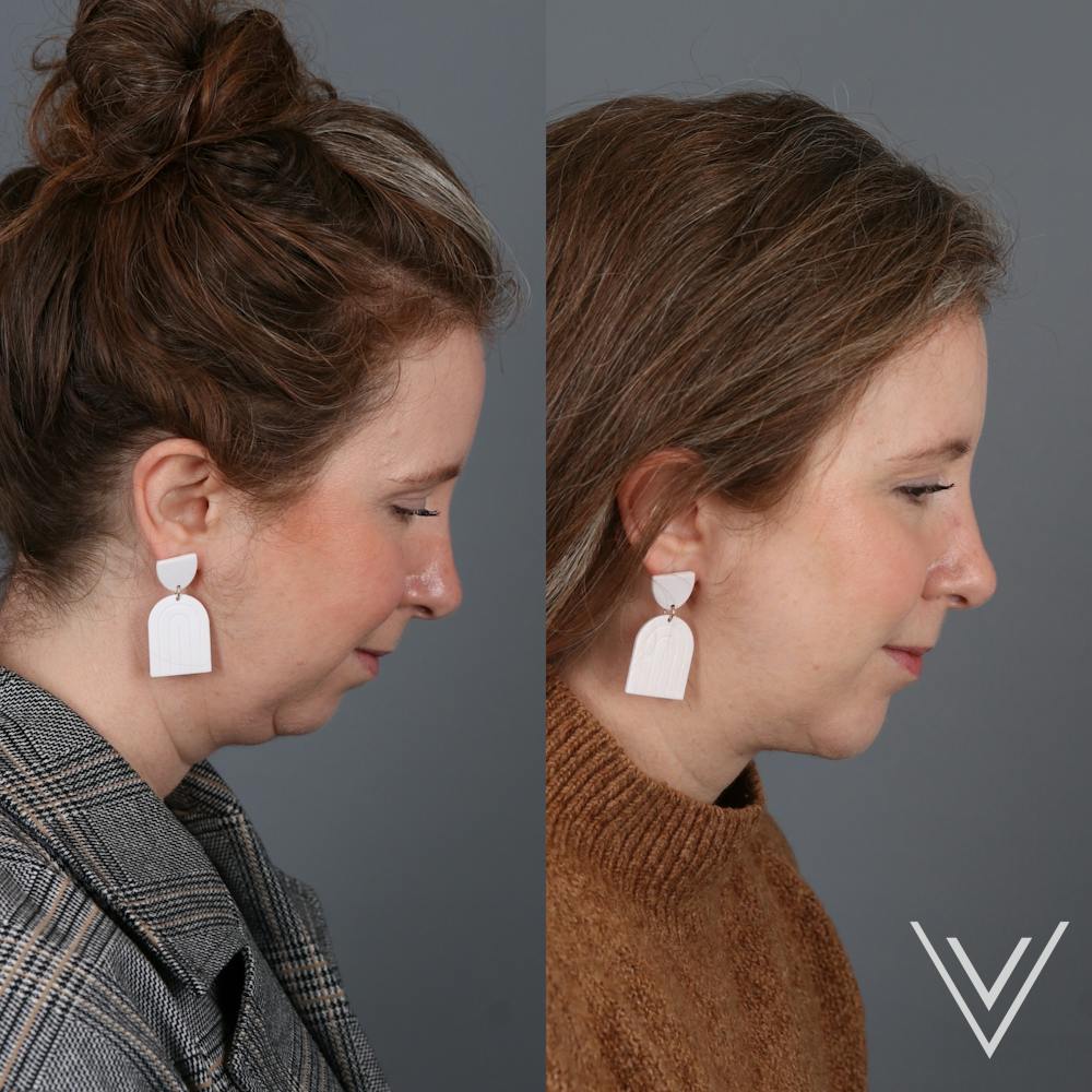 Chin Implant Before & After Gallery - Patient 405064 - Image 2