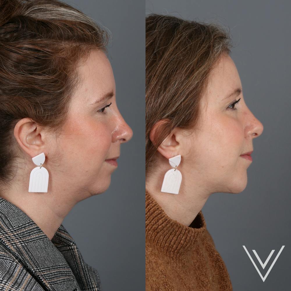 Chin Implant Before & After Gallery - Patient 405064 - Image 1