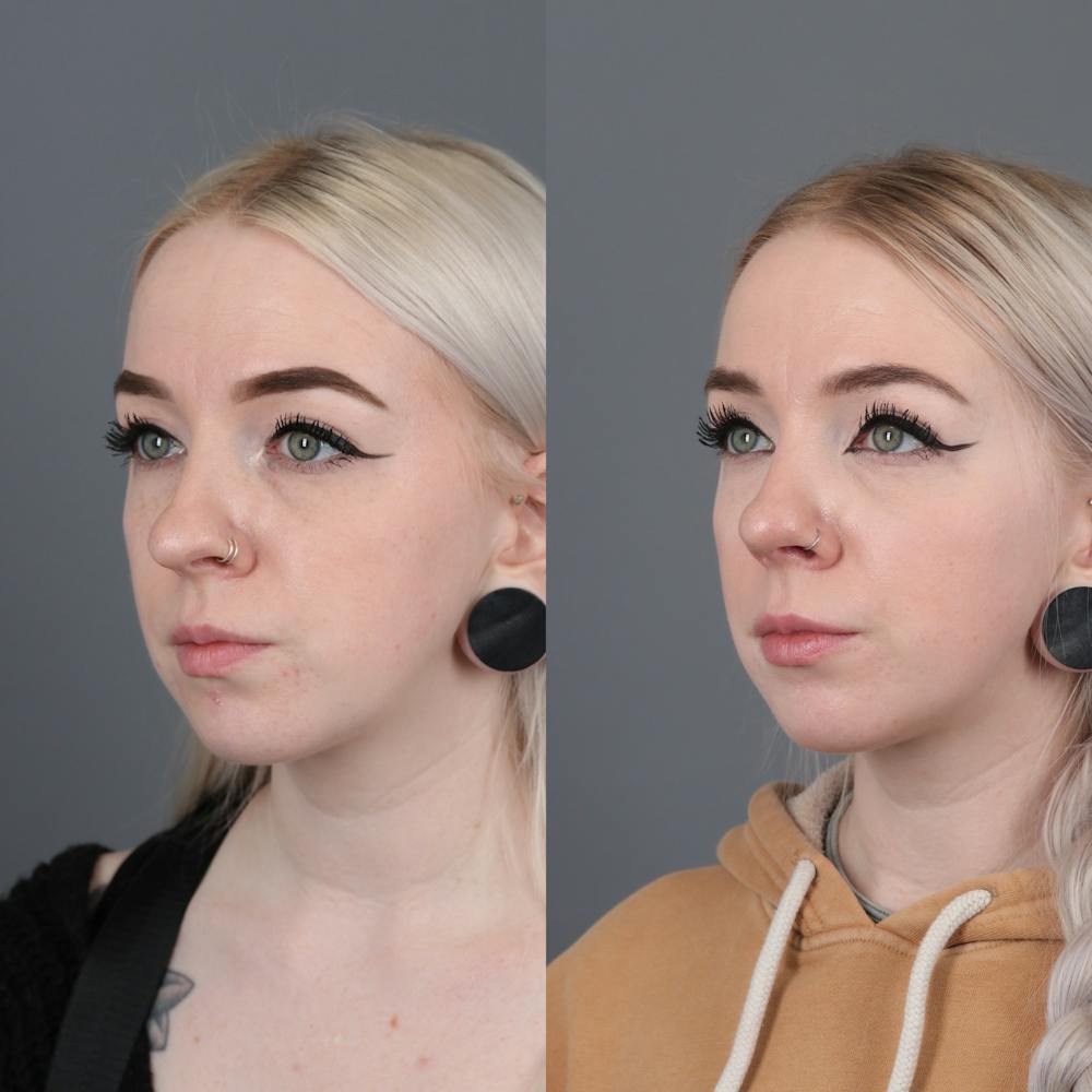 Rhinoplasty Before & After Gallery - Patient 422614 - Image 3