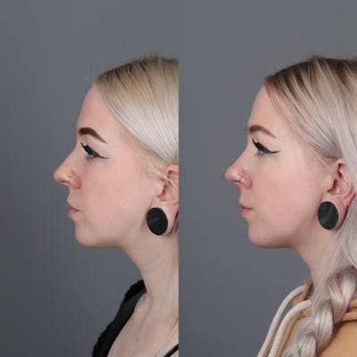 Rhinoplasty Before & After Gallery - Patient 422614 - Image 1
