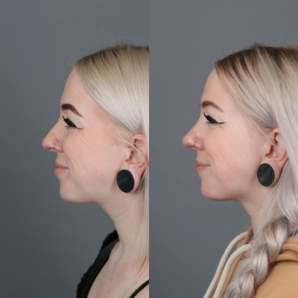 Rhinoplasty Before & After Gallery - Patient 422614 - Image 4