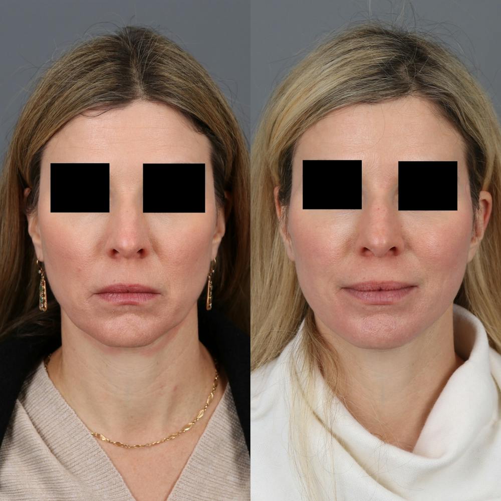 Face & Neck Lift Before & After Gallery - Patient 245888 - Image 4