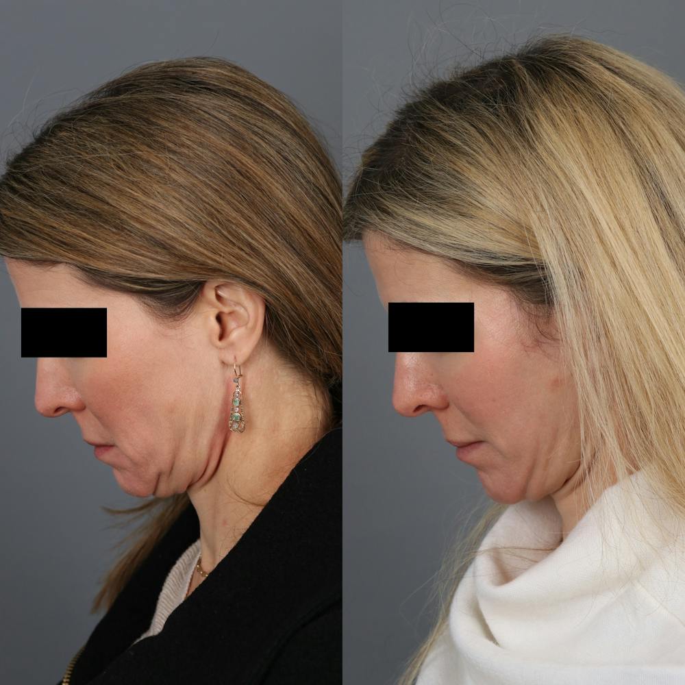 Face & Neck Lift Before & After Gallery - Patient 245888 - Image 3