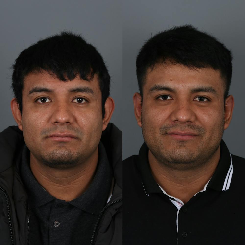 Otoplasty Before & After Gallery - Patient 271914 - Image 1