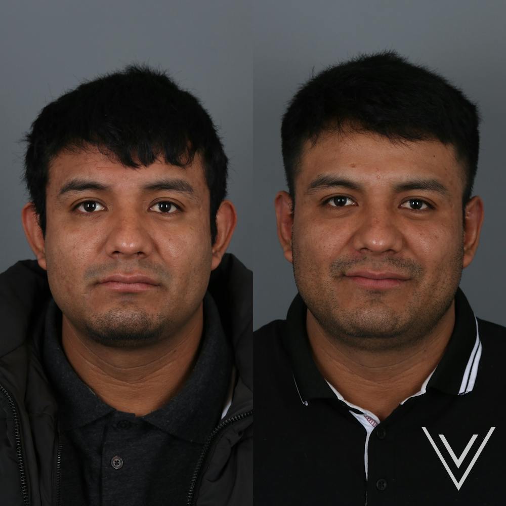 Otoplasty Before & After Gallery - Patient 271914 - Image 1