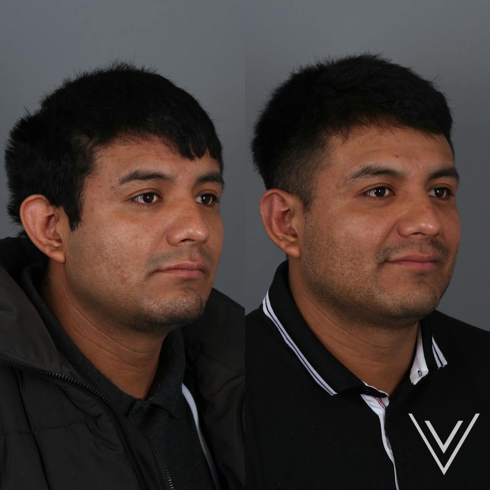 Otoplasty Before & After Gallery - Patient 271914 - Image 2