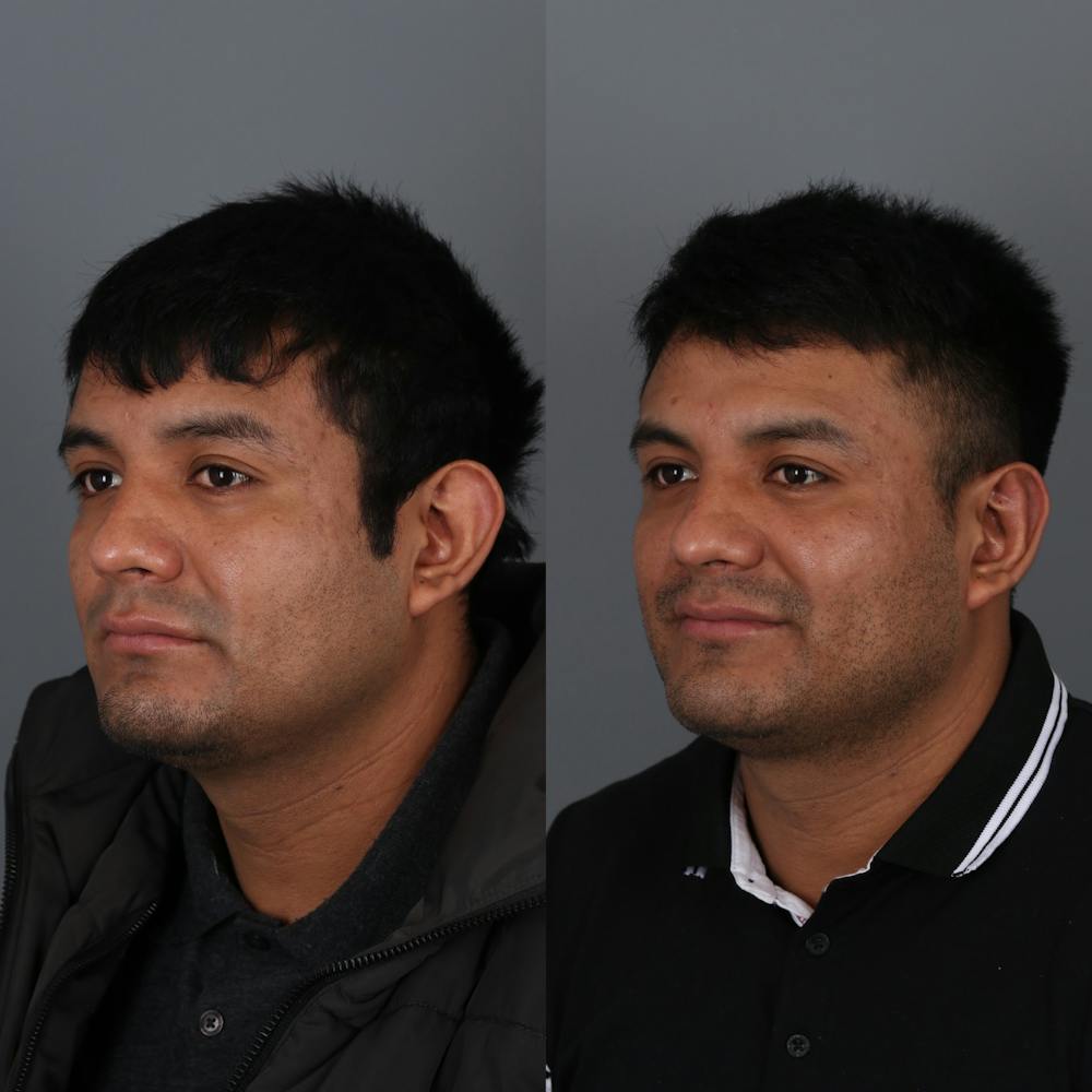 Otoplasty Before & After Gallery - Patient 271914 - Image 3