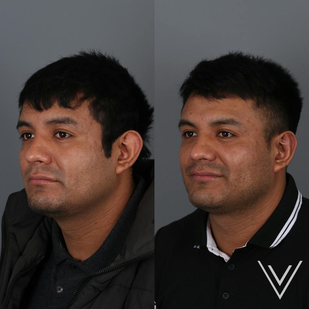 Otoplasty Before & After Gallery - Patient 271914 - Image 3