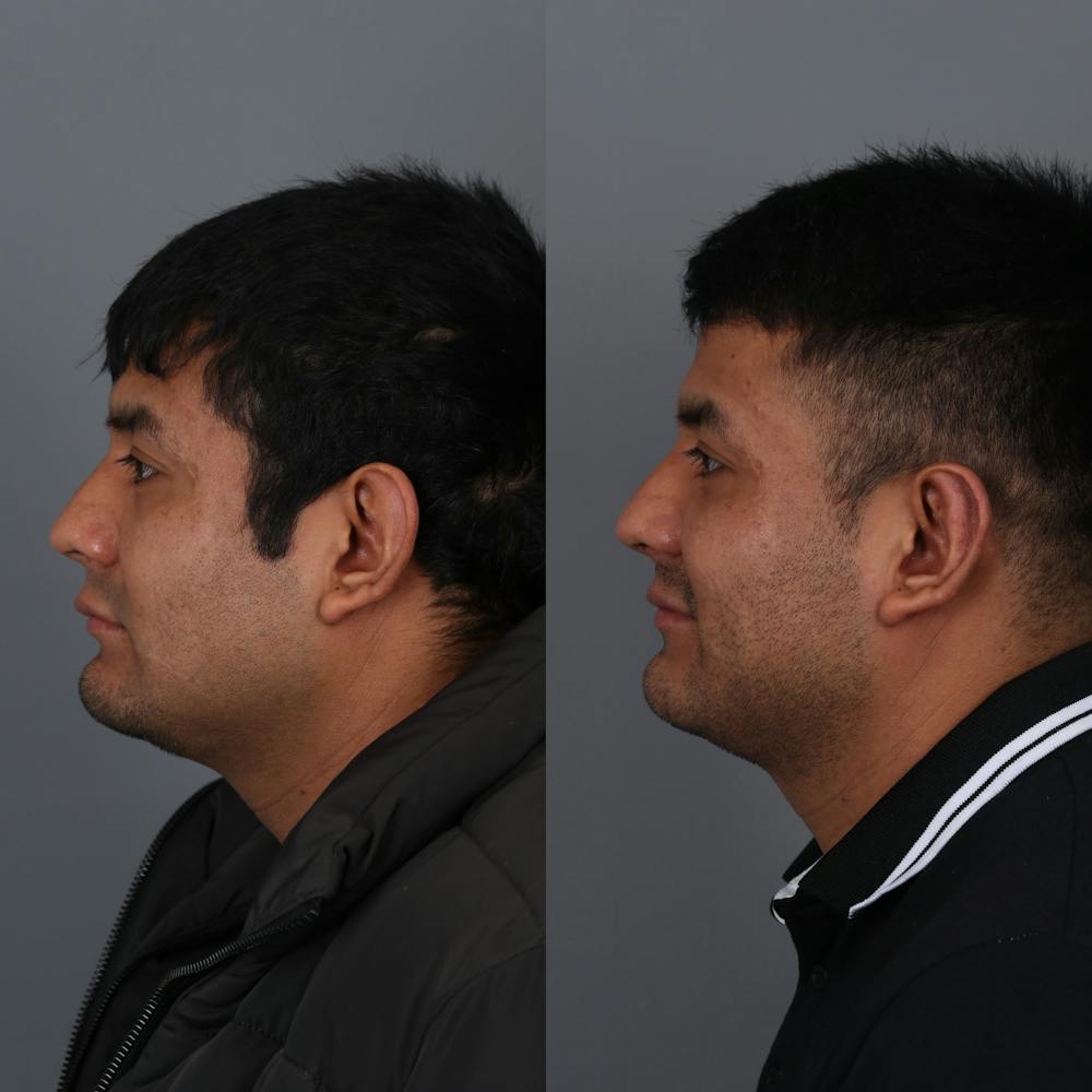 Otoplasty Before & After Gallery - Patient 271914 - Image 4