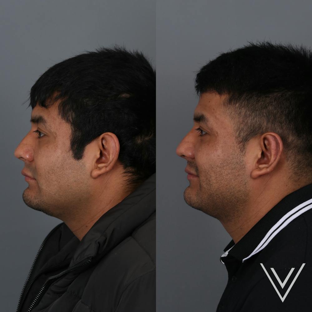 Otoplasty Before & After Gallery - Patient 271914 - Image 4