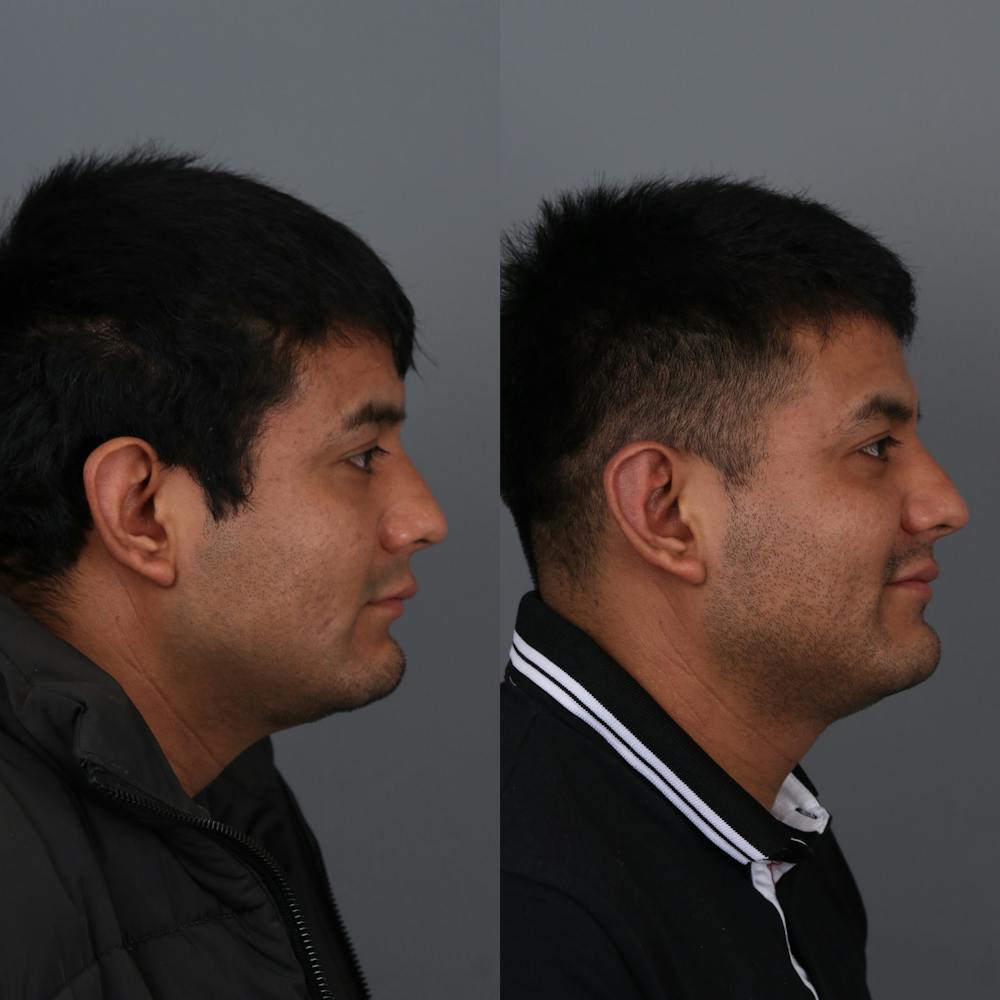 Otoplasty Before & After Gallery - Patient 271914 - Image 5