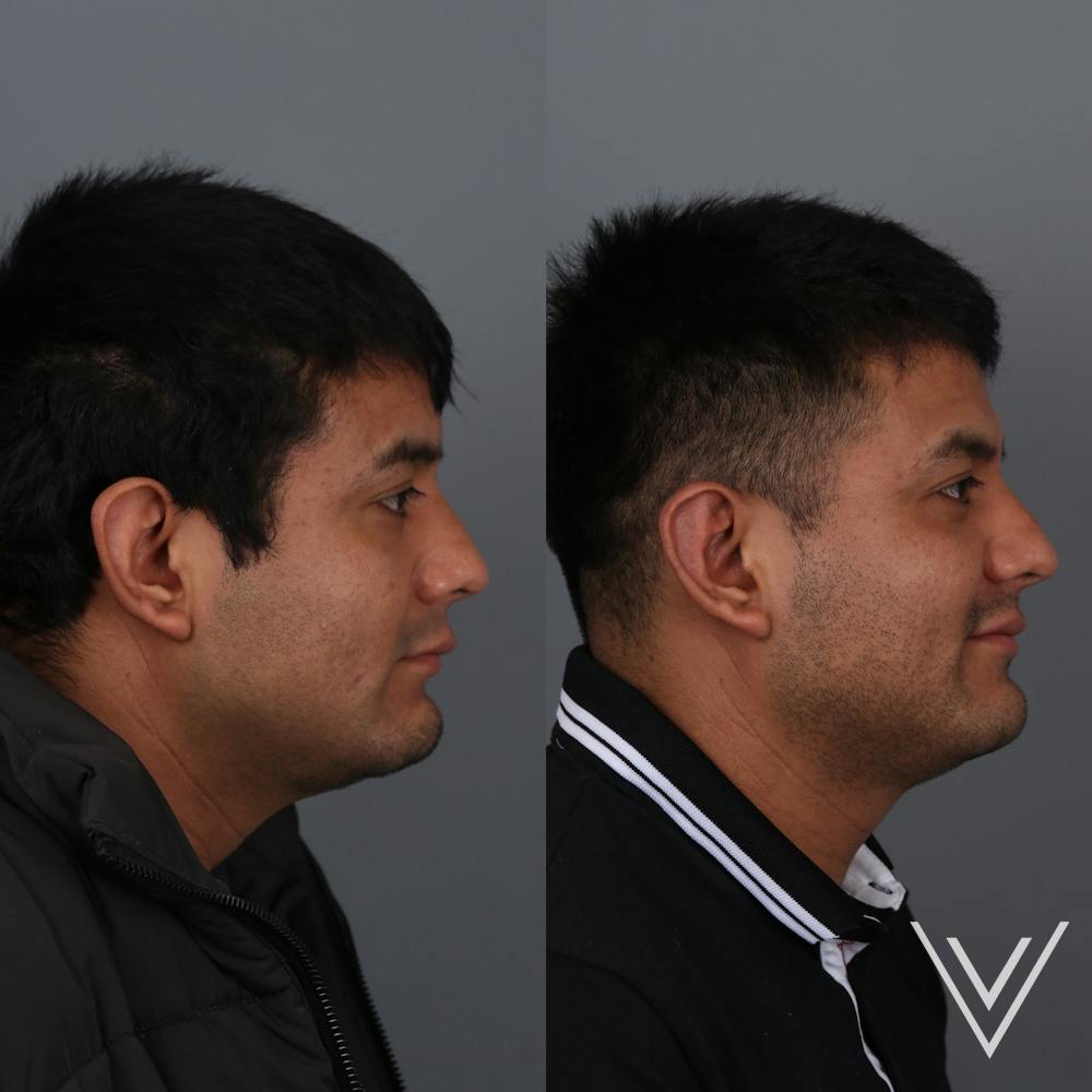 Otoplasty Before & After Gallery - Patient 271914 - Image 5