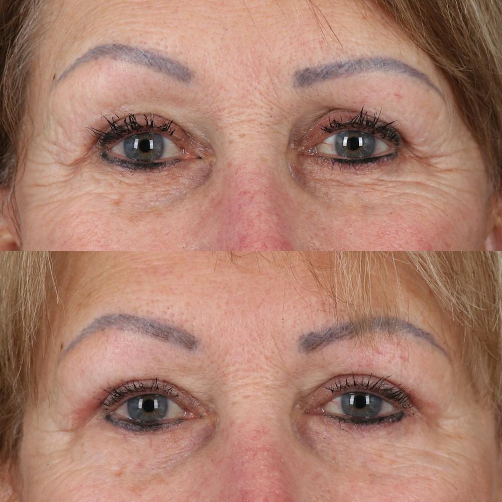 Upper Blepharoplasty Before & After Gallery - Patient 761691 - Image 1