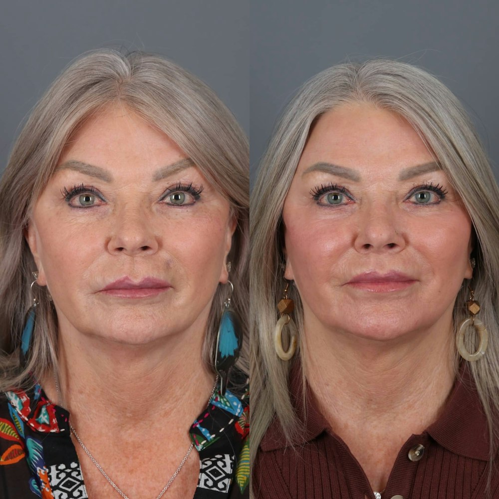 Lip Lift in Portland Before & After Photos