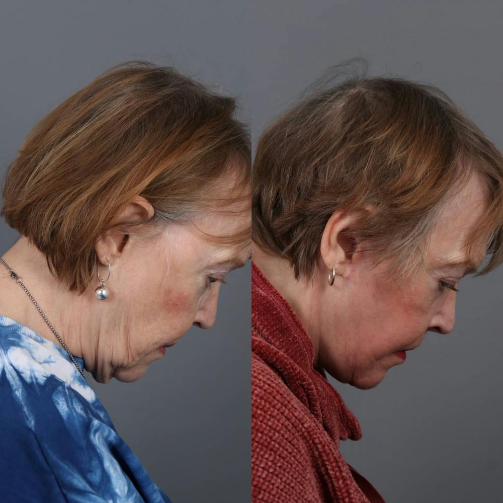 Face & Neck Lift Before & After Gallery - Patient 266842 - Image 3