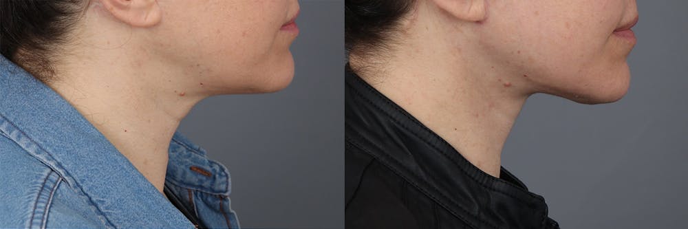 Face & Neck Lift Before & After Gallery - Patient 422730 - Image 2