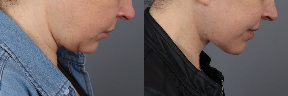 Face & Neck Lift Before & After Gallery - Patient 422730 - Image 3