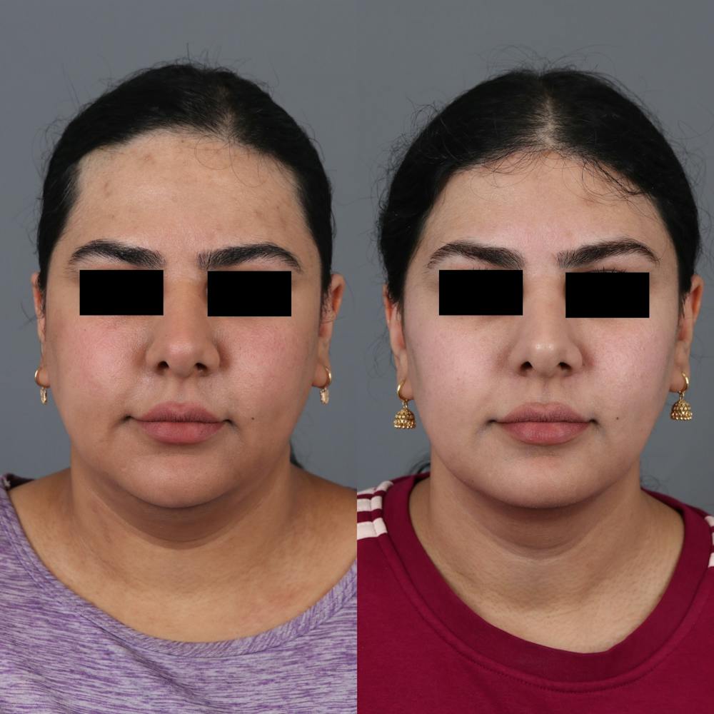 Forehead Reduction Before & After Gallery - Patient 307060 - Image 1