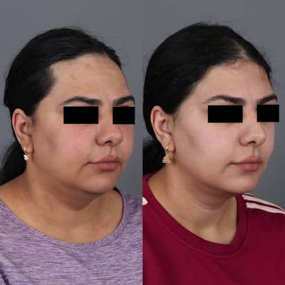 Forehead Reduction Before & After Gallery - Patient 307060 - Image 2
